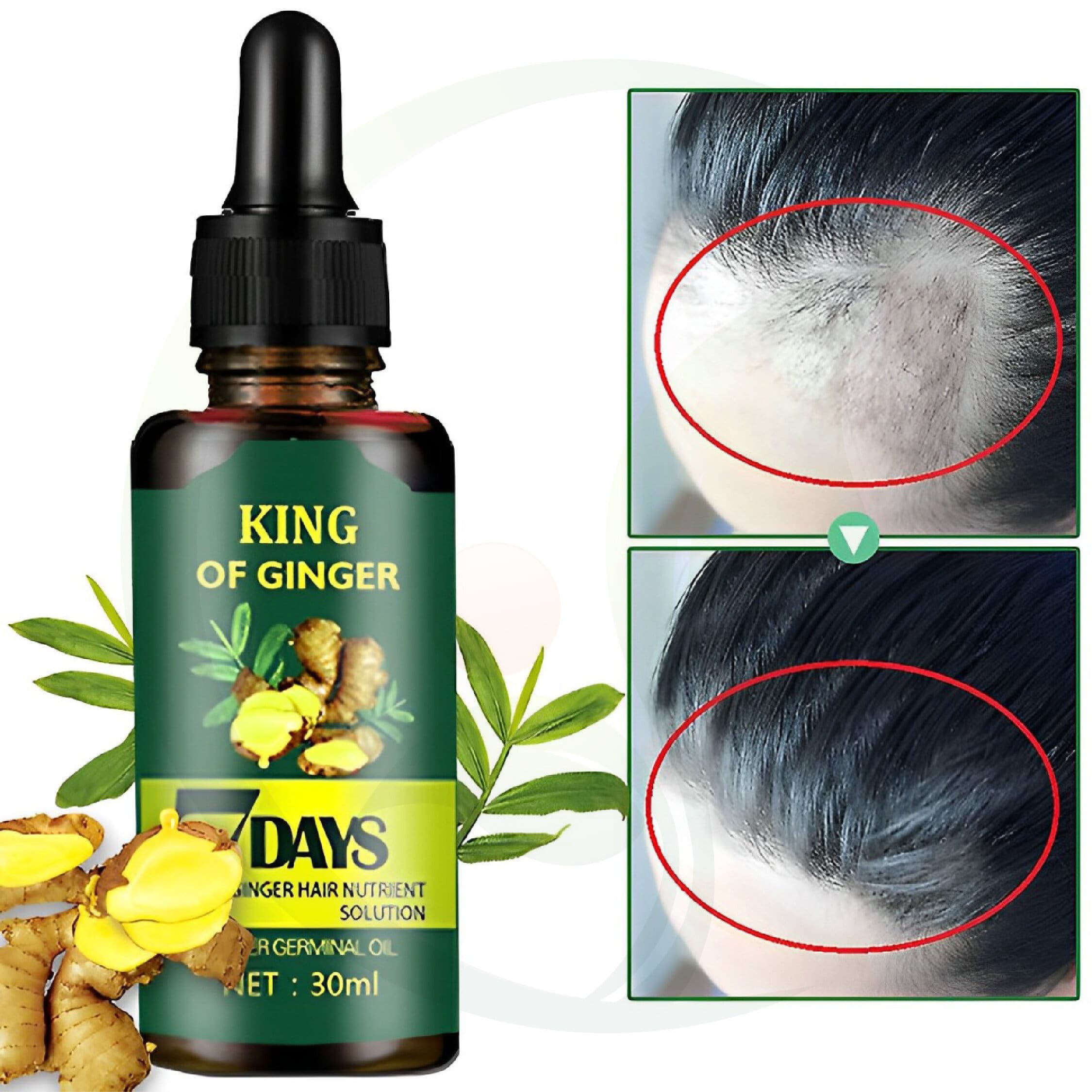 Bottle of King of Ginger hair nutrient solution with a before and after comparison showing improved hair growth on a person's scalp.